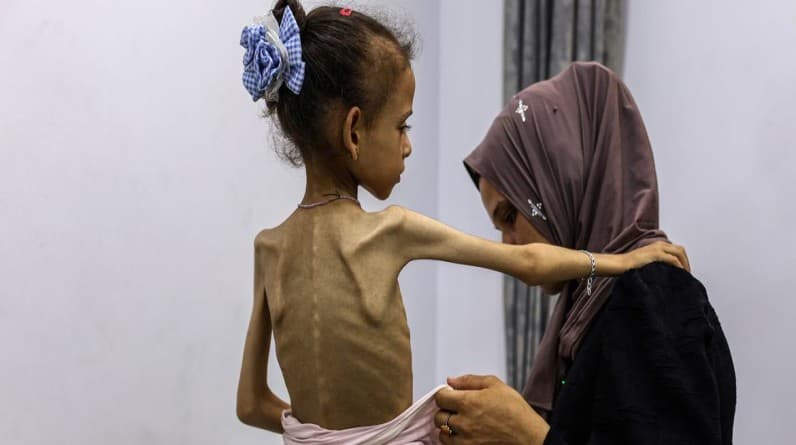 المكتب الإعلامى: ارتفاع عدد ضحايا الجوع وسوء التغذية إلى 313 شهيداً