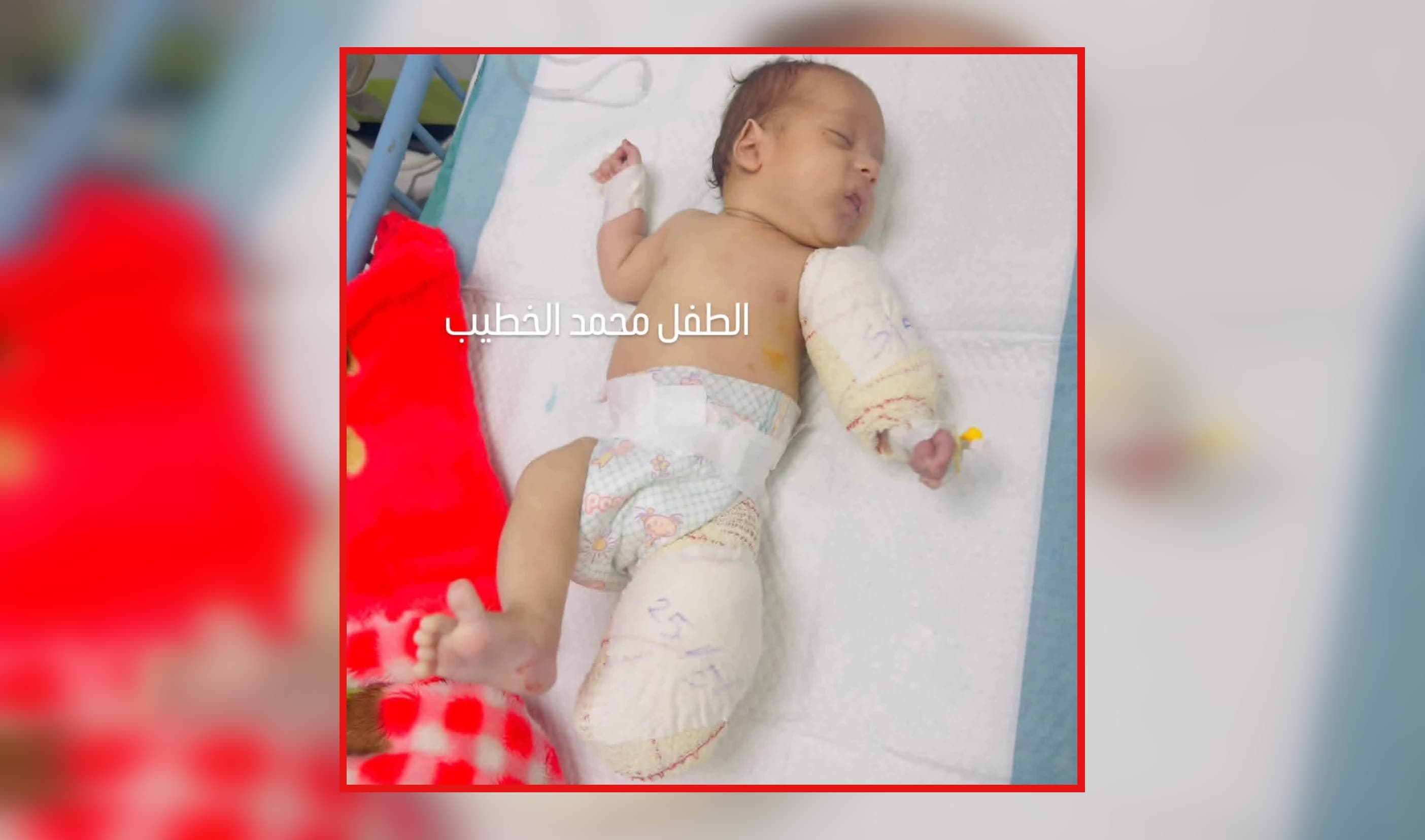 بلا أم وبلا ساق.. قصة الرضيع محمد الخطيب تجسد مأساة أطفال غزة