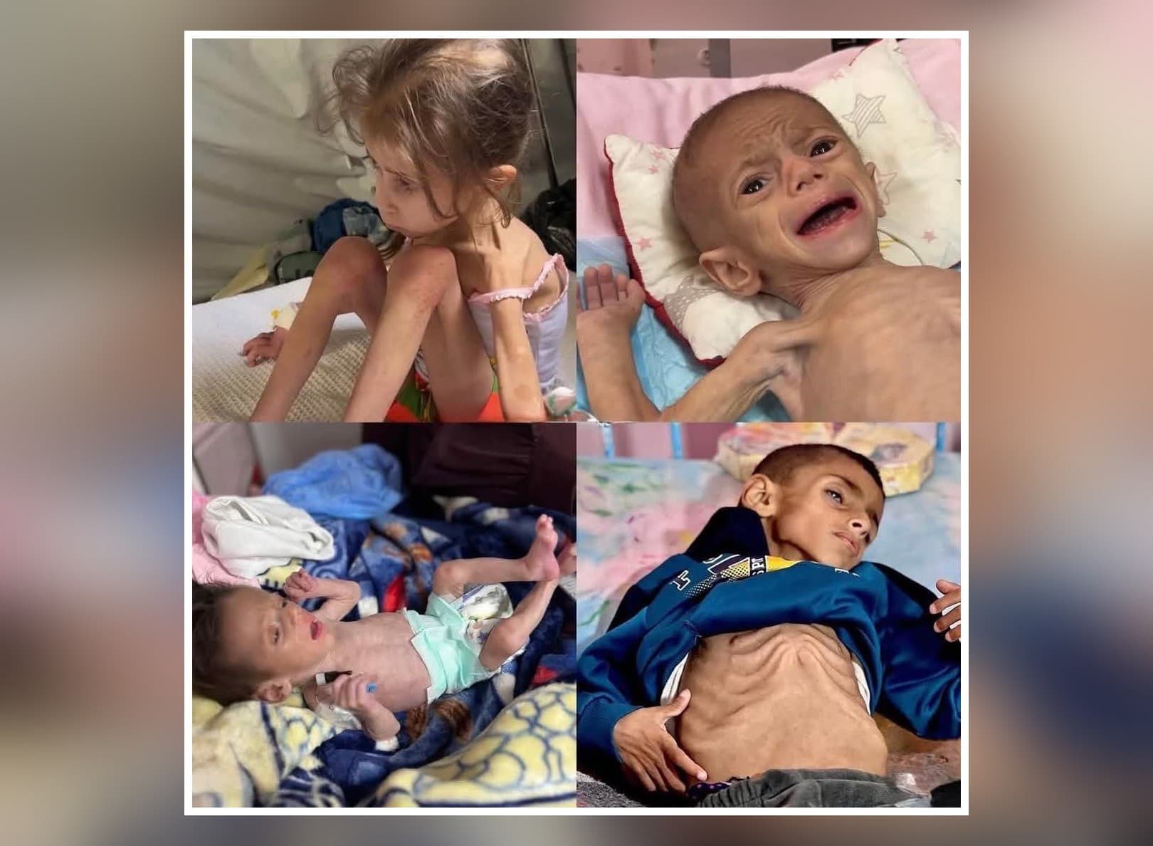 أكثر من 100 ألف طفل و37 ألف امرأة يواجهون سوء التغذية الحادة بغزة