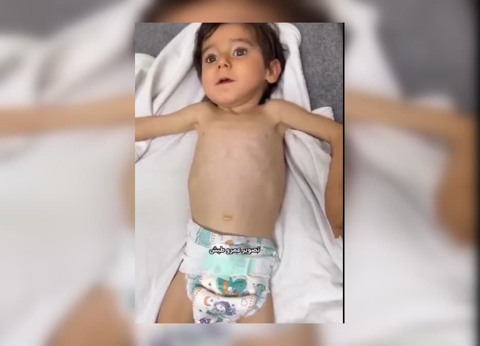 سوء التغذية يفتك بالأطفال في غزة