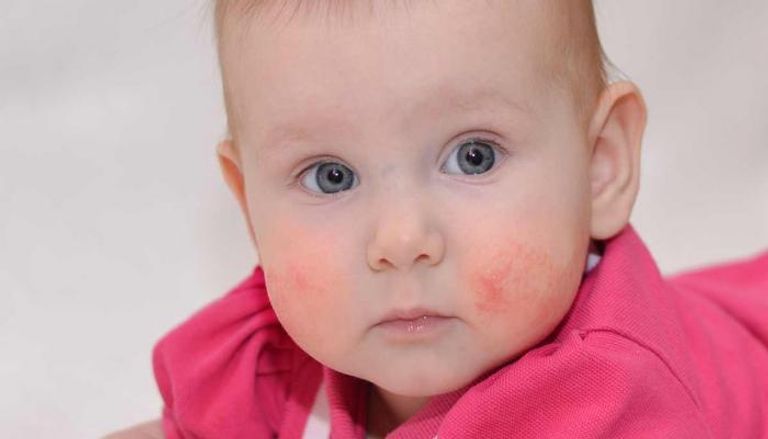 حساسية الألبان عند الرضع.. الأعراض وسبل الوقاية